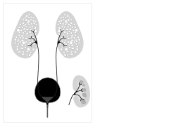 Cartoon of autosomal recessive polycystic kidney disease with normal kidney inset to right of diagram