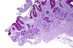 Atrophic gastritis showing patchy atrophy of oxyntic mucosa