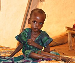 A child in Dolo Ado facing malnutrition