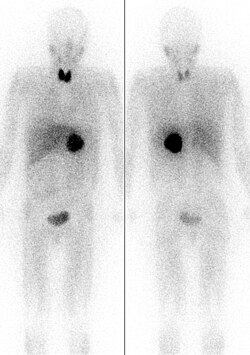 Pheochromocytoma seen like a dark sphere in center of the body. Image is by MIBG scintigraphy with radiation from radioiodine in the MIBG. Note unwanted uptake of radioiodine from the pharmaceutical by the thyroid gland in the neck, in both images (front and back) of the same patient. Radioactivity is also seen in the bladder.