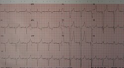 An ECG of a person with a dual-chamber pacemaker