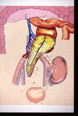 Kidney-pancreas transplant