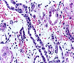 Presence of lymphocytes within the tubular epithelium, attesting to acute cellular rejection of a renal graft. Biopsy sample.