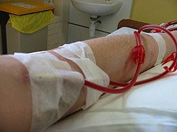 Hemodialysis in progress