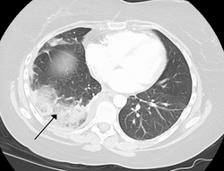 Tissue death of the lung due to a pulmonary embolism