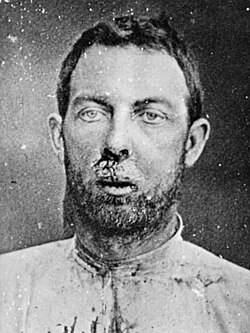 A wounded Jim Younger after his arrest in 1876