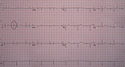 An ECG in a person with a single-chamber pacemaker to the atrium. Note the circle around one of the sharp electrical spikes in the position where the P wave would be expected.