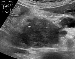 Abdominal ultrasonography of pancreatic cancer (presumably adenocarcinoma), with a dilated pancreatic duct to the right