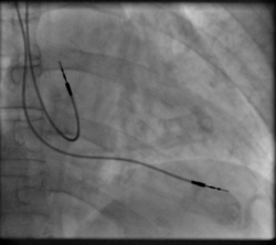 Right atrial and right ventricular leads as visualized under x-ray during a pacemaker implant procedure. The atrial lead is the curved one making a U shape in the upper left part of the figure.
