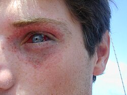 Eye and surrounding skin of young male showing petechial and subconjunctival haemmorhages
