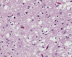 Magnified 100× and stained. This photomicrograph of the brain tissue shows the presence of the prominent spongiotic changes in the cortex, with the loss of neurons in a case of a variant of Creutzfeldt-Jakob disease (vCJD).