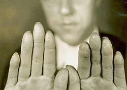 Criminal Alvin Karpis had his fingerprints surgically removed in 1933