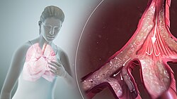 3D still image of constricted airways as in bronchial asthma