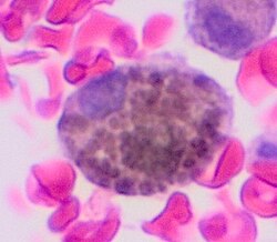 Melanophage. H&E stain.