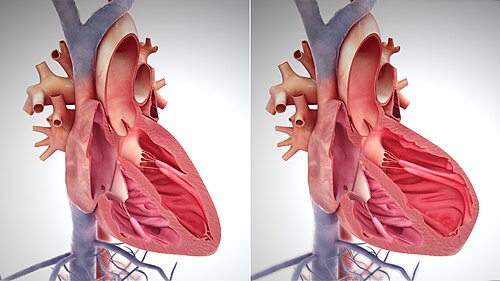 Model of a normal heart (left); and a weakened heart, with over-stretched muscle and dilation of left ventricle (right); both during diastole