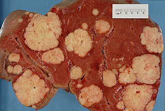 Cross-section of a human liver, at autopsy, showing many large pale tumor deposits, that are secondary tumors derived from pancreatic cancer
