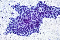 Fine needle aspiration of well-differentiated pancreatic adenocarcinoma, showing a flat sheet with prominent honeycombing. The disorganization, nuclear overlapping, and lack of uniform nuclear spacing provides a clue that this is adenocarcinoma (as opposed to non-neoplastic duct epithelium).