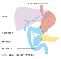 Parts of the body removed in Whipple's operation