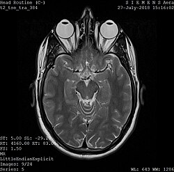 One frame of an MRI scan of the head showing the eyes and brain