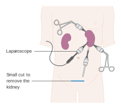 Laparoscopic nephrectomy