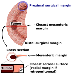 Margins of a colonic resection
