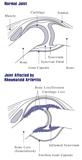 A diagram showing how rheumatoid arthritis affects a joint