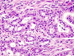 Micrograph of pancreatic ductal adenocarcinoma (the most common type of pancreatic cancer), H&E stain