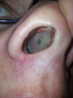 Nasal septum perforation caused by cocaine insufflation (pictured) can progress to cocaine-induced midline destructive lesions