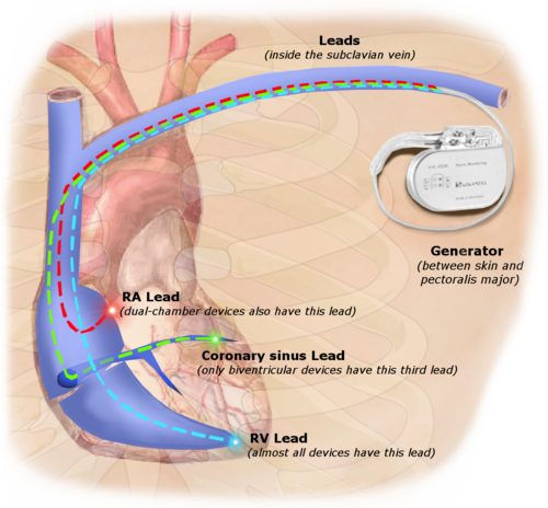 Illustration of implanted cardiac pacemaker showing locations of cardiac pacemaker leads