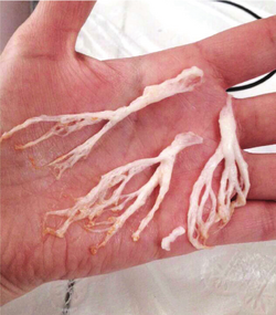 Plastic bronchitis bronchial casts[80]