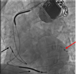Three leads can be seen in this example of a cardiac resynchronization device: a right atrial lead (solid black arrow), a right ventricular lead (dashed black arrow), and a coronary sinus lead (red arrow). The coronary sinus lead wraps around the outside of the left ventricle, enabling pacing of the left ventricle. Note that the right ventricular lead in this case has two thickened aspects that represent conduction coils and that the generator is larger than typical pacemaker generators, demonstrating that this device is both a pacemaker and a cardioverter-defibrillator, capable of delivering electrical shocks for dangerously fast abnormal ventricular rhythms.