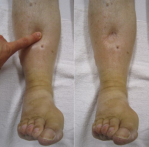 Severe peripheral pitting edema