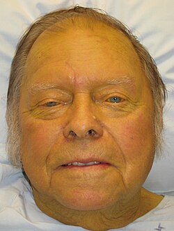 Jaundice can be a symptom, due to biliary obstruction from a pancreatic tumor.