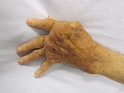Rheumatoid arthritis