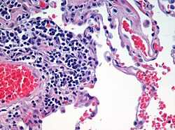 Microscopic view of a histologic specimen of human lung, consisting of various tissues: blood, connective tissue, vascular endothelium and respiratory epithelium, stained with hematoxylin and eosin.