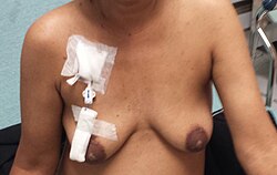 Permacath for dialysis