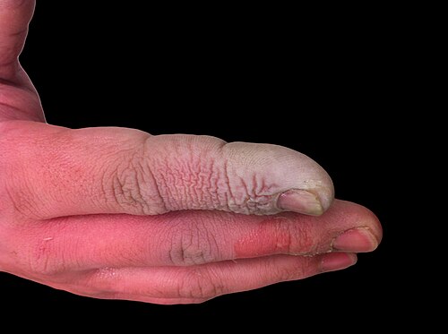A hydrofluoric acid burn of the hand