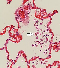 Siderophages (one indicated by white arrow) and pulmonary congestion, indicating left congestive heart failure