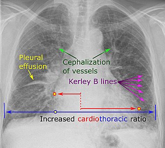 Chest radiograph of a lung with distinct Kerley B lines, as well as an enlarged heart (as shown by an increased cardiothoracic ratio, cephalization of pulmonary veins, and minor pleural effusion as seen for example in the right horizontal fissure. Yet, no obvious lung edema is seen. Overall, this indicates intermediate severity (stage II) heart failure.