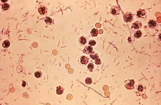 A photomicrograph of a stool that has shigella dysentery. These bacteria typically cause foodborne illness.