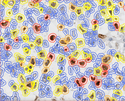 Ki-67 stain calculation by the open-source software QuPath in a pure seminoma, which gives a measure of the proliferation rate of the tumor. The colors represent the intensity of expression: blue-no expression, yellow-low, orange-moderate, and red-high expression.[92]