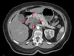 Axial CT image with IV contrast and added color: Cross lines towards top left surround a macrocystic adenocarcinoma of the pancreatic head.