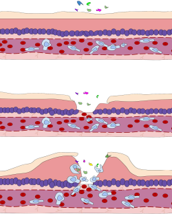Inflammation is a process by which the body's white blood cells and substances they produce protect us from infection with foreign organisms, such as bacteria and viruses. The (phagocytes) white blood cells are a nonspecific immune response, meaning that they attack any foreign bodies. However, in some diseases, like arthritis, the body's defense system the immune system triggers an inflammatory response when there are no foreign invaders to fight off. In these diseases, called autoimmune diseases, the body's normally protective immune system causes damage to its own tissues. The body responds as if normal tissues are infected or somehow abnormal.