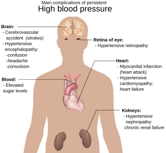 Overview of main complications of persistent high blood pressure.[41]