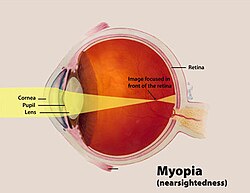 Anatomical diagram of myopia, or nearsightedness