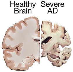 Brain atrophy in severe Alzheimer's