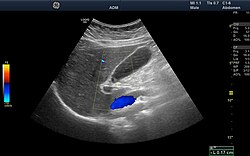 Ultrasound image showing the liver, gallbladder and common bile duct.