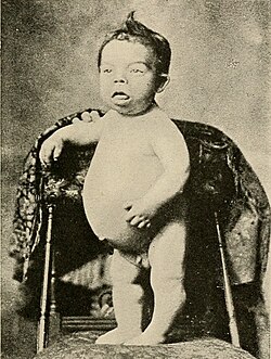 Child affected by Congenital iodine deficiency syndrome, associated with a lack of iodine.[75]