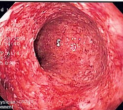 Colitis (inflammation of the colon) caused by Crohn's disease.