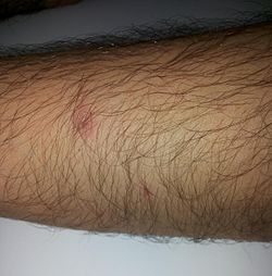 Superficial chemical burn caused by two 98% sulfuric acid splashes (forearm skin)